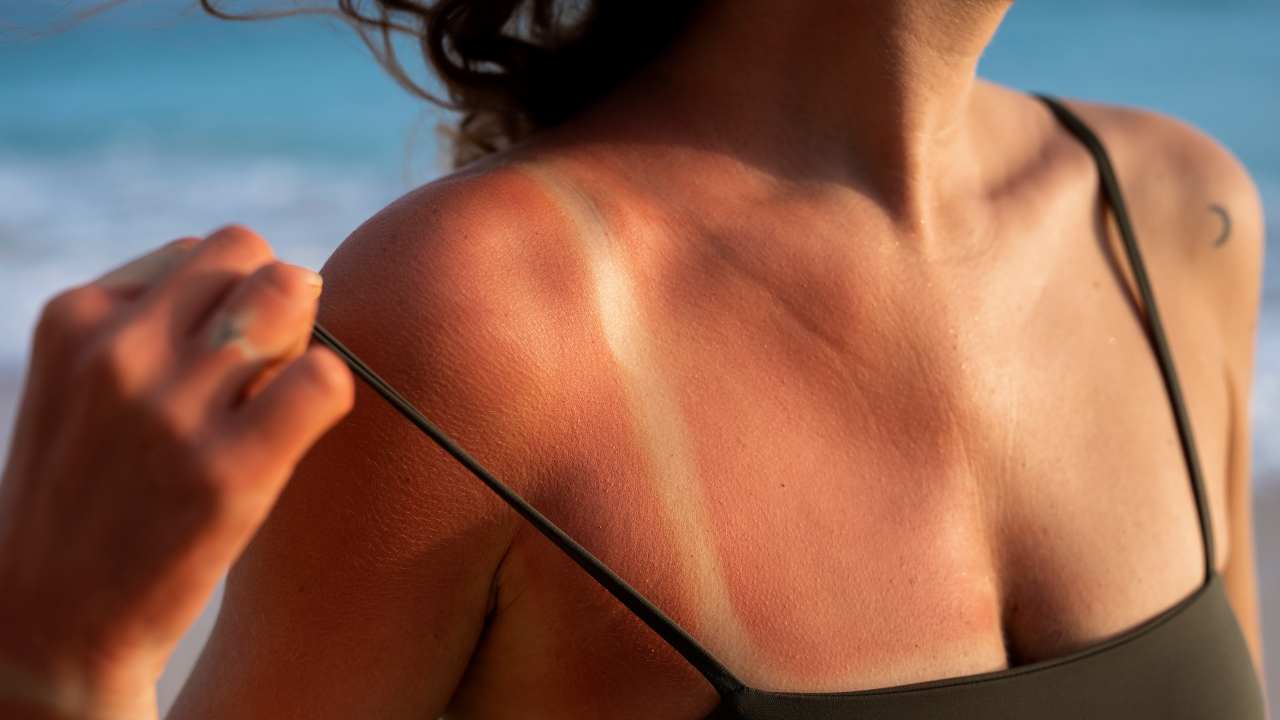 La prima mossa da fare dopo una scottatura