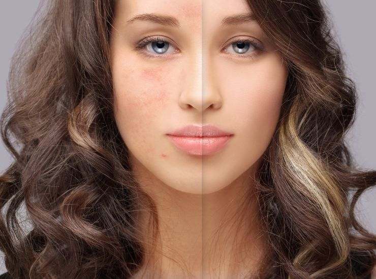 Prima e dopo acne
