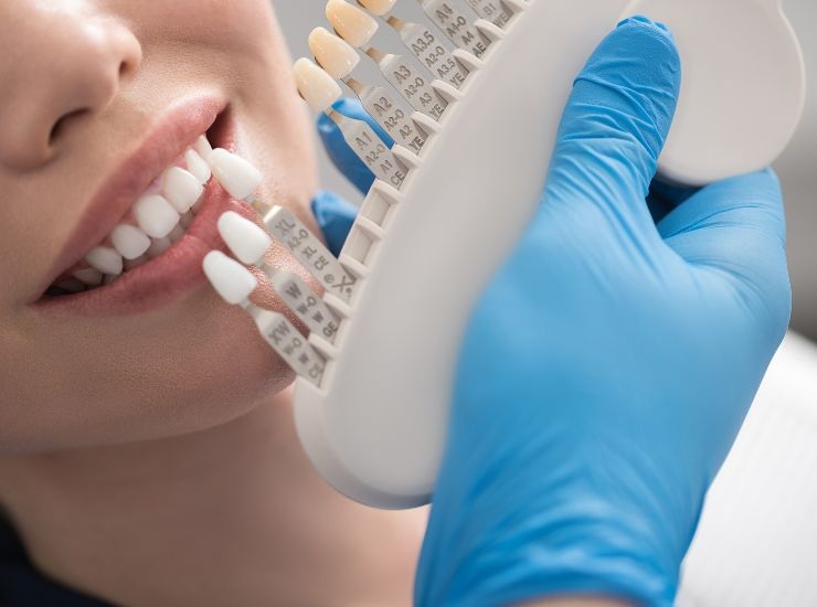 Tecnica dello sbiancamento dentale